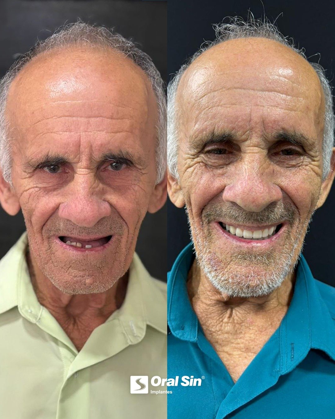 Antes e depois de tratamento com implantes - Oral Sin Barretos