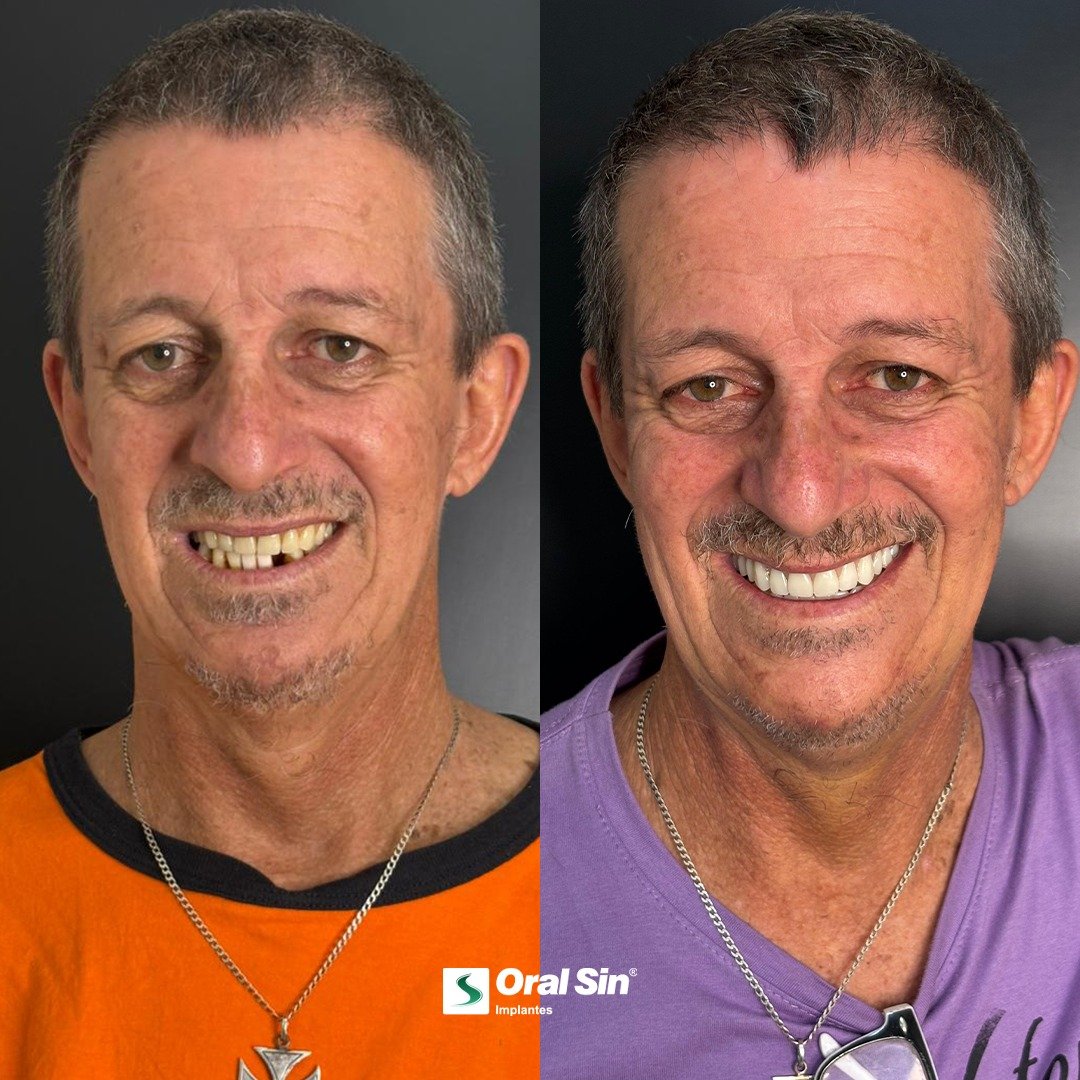 Antes e depois de tratamento com implantes - Oral Sin Barretos