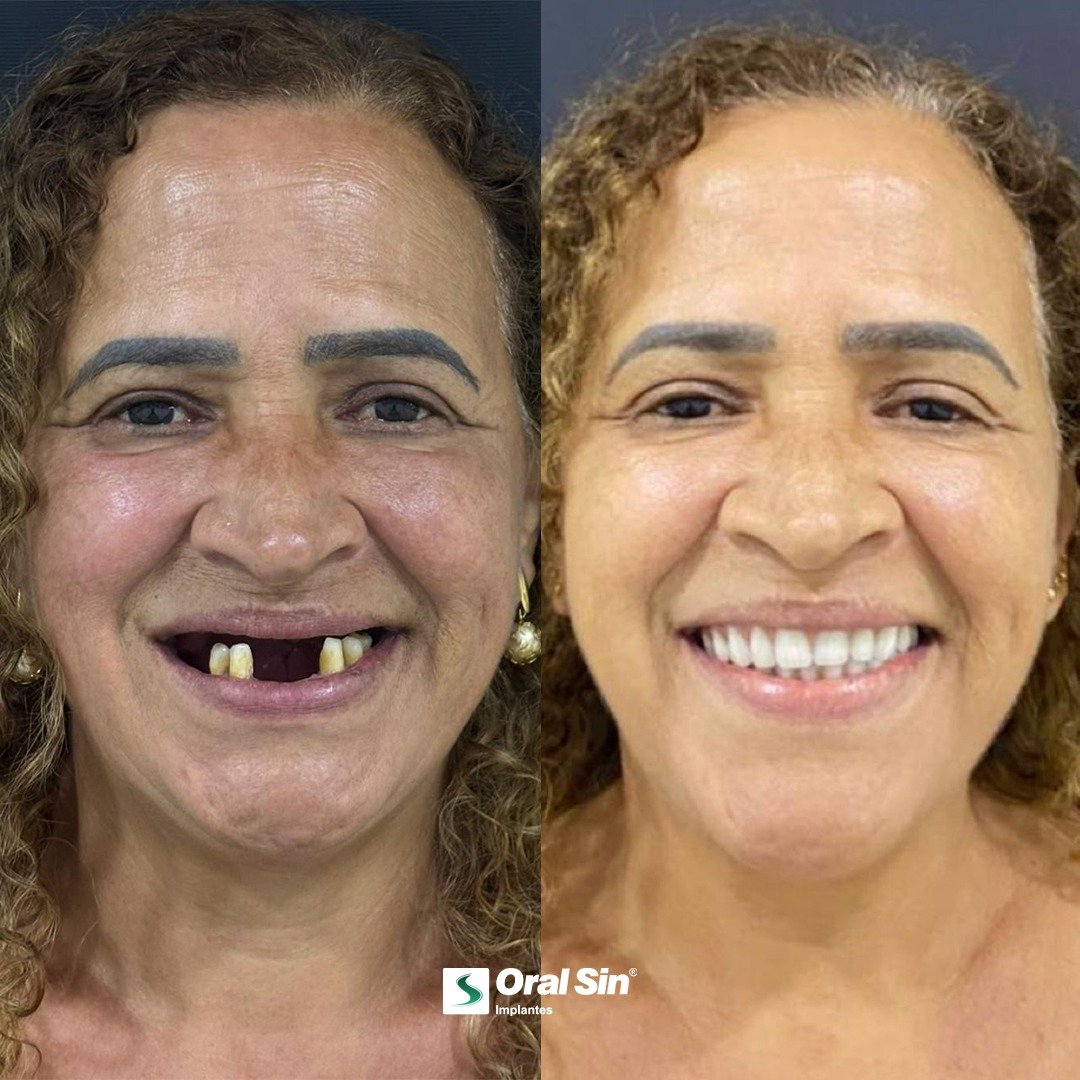 Antes e depois de tratamento com implantes - Oral Sin Barretos