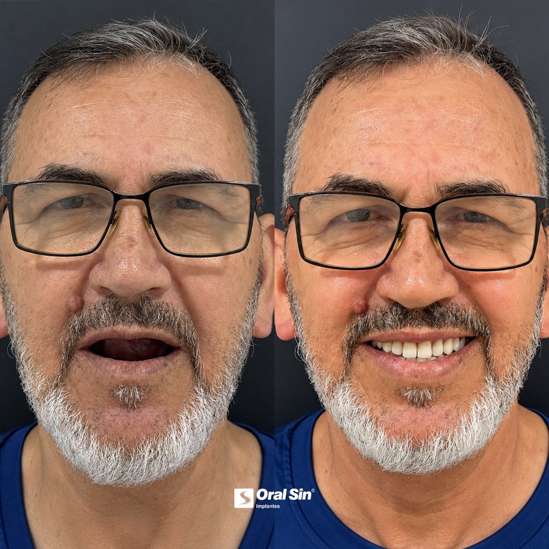 Antes e depois de tratamento com implantes - Oral Sin Barretos