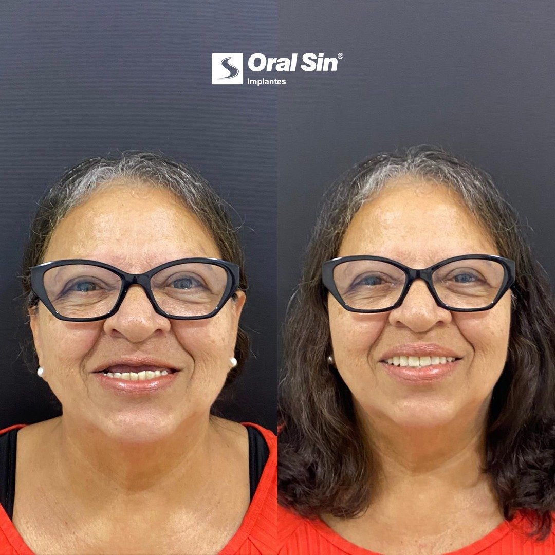 Antes e depois de tratamento com implantes - Oral Sin Barretos