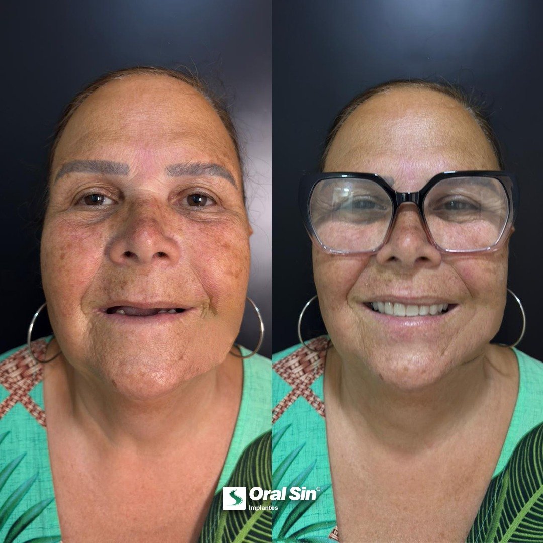 Antes e depois de tratamento com implantes - Oral Sin Barretos
